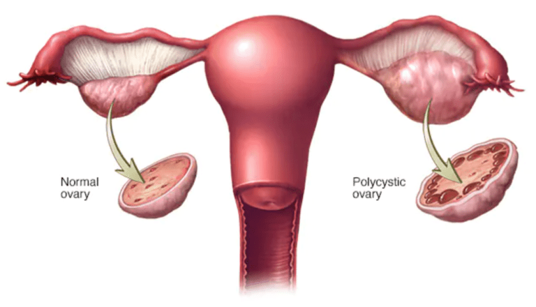 पीसीओडी (पॉलीसिस्टिक ओवेरियन सिंड्रोम)