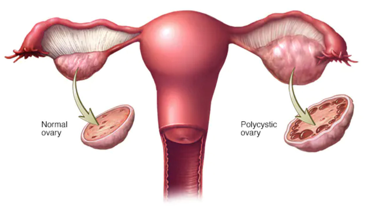 PCOD (Polycystic Ovarian Syndrome)