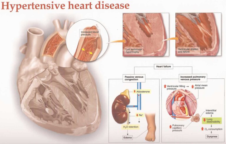 Role of Hypertension in Genesis of Heart Diseases