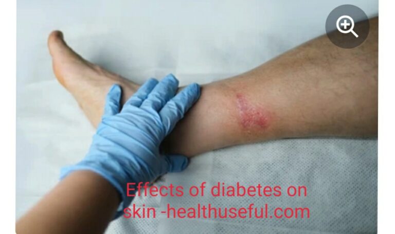 Effects of diabetes on  skin -part 2