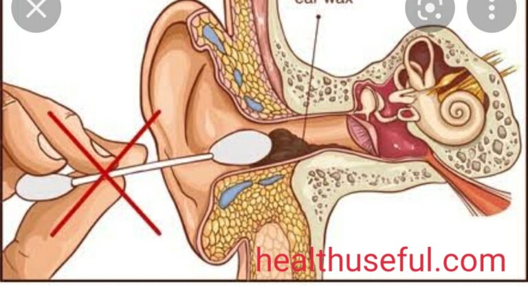 Ear wax-Part-2