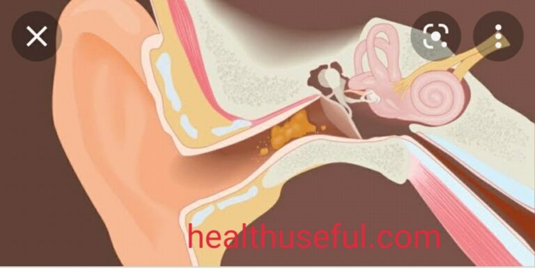 Ear wax-Part-1