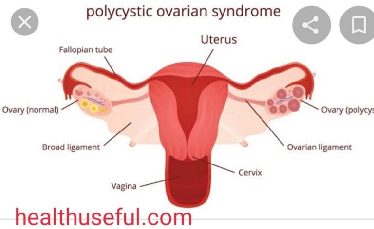 PCOD (Polycystic Ovarian Syndrome)-part-2