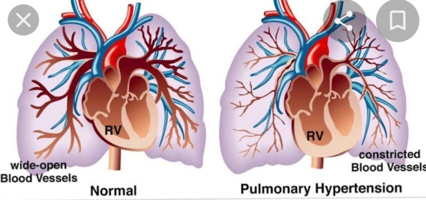 Pulmonary hypertension - Symptoms and causes