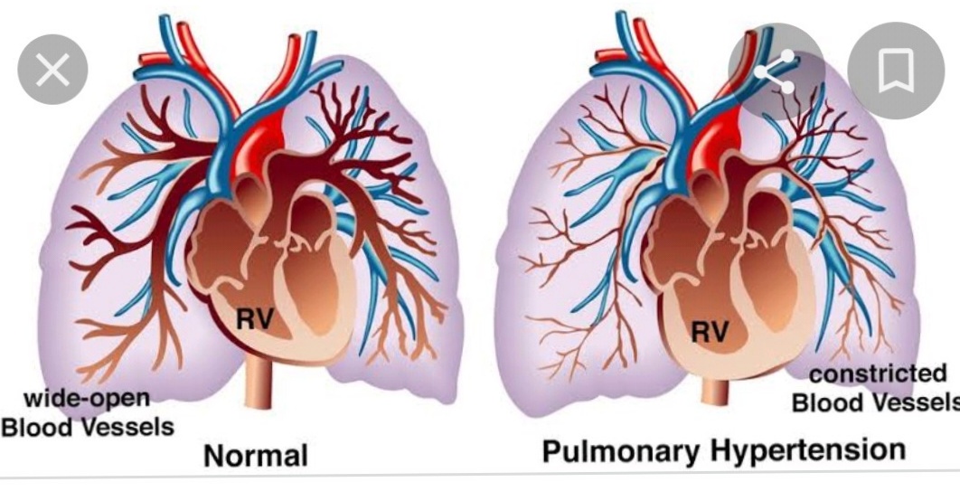 Pulmonary hypertension - Symptoms and causes