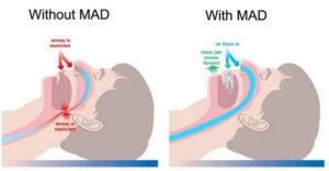 Image of Sleep apnea Symptoms and Causes