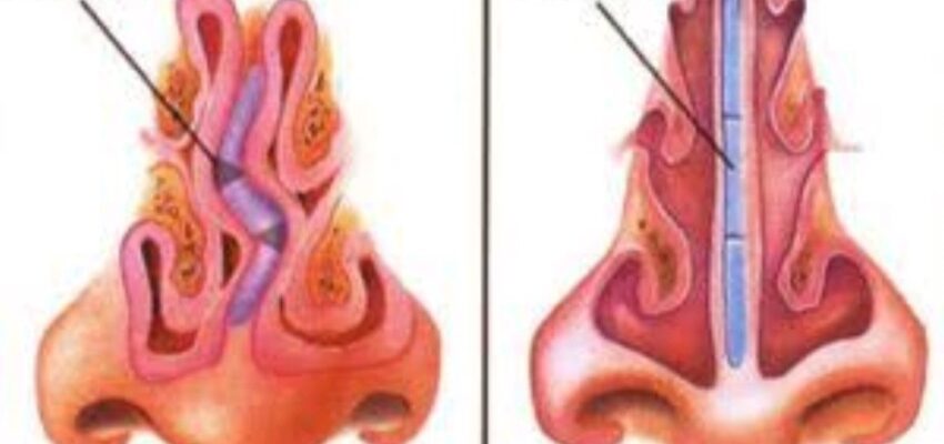 What is Septoplasty | Septoplasty Procedure, Risks, and Recovery