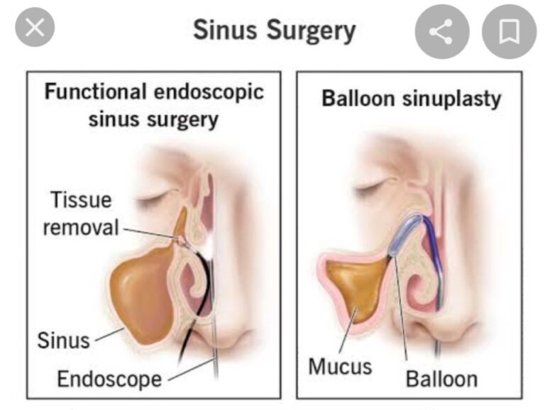 Sinus Surgery