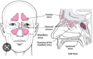 Complications Of Sinusitis