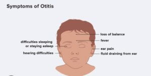 Otitis Media Paediatric