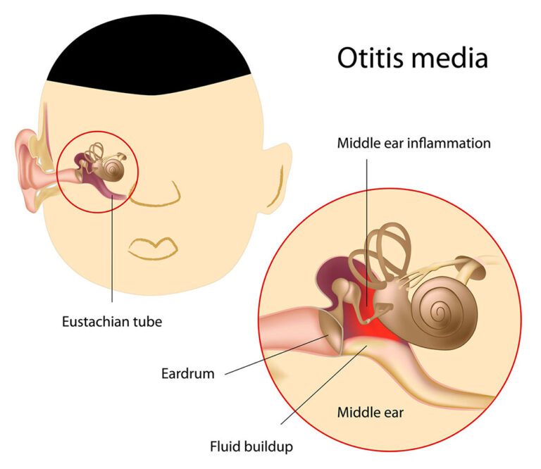 Otitis Media Nonsuppurative