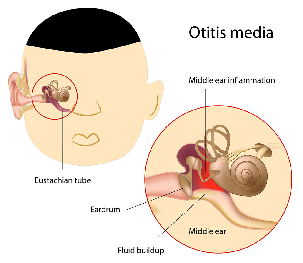 Otitis Media Nonsuppurative