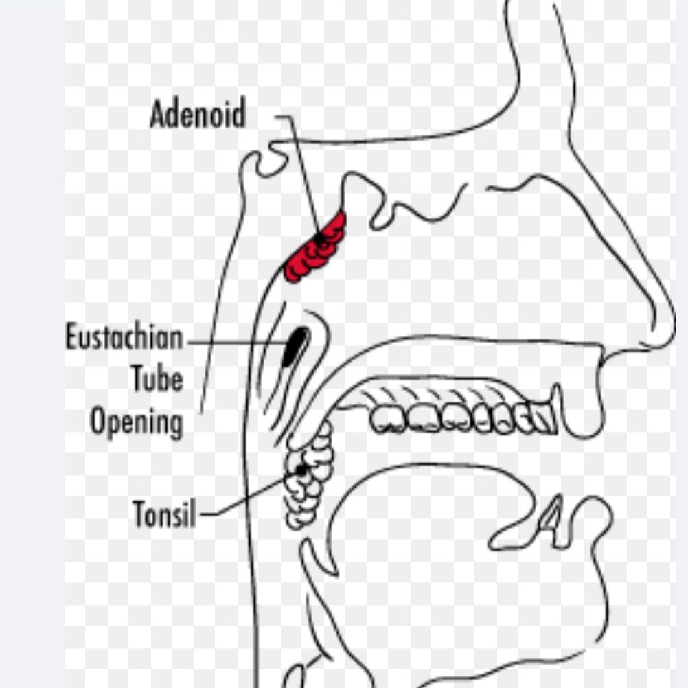 Image -Adenoidectomy Surgery