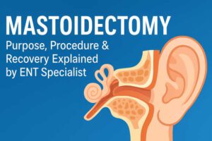 Mastoidectomy Surgery: Purpose, Procedure & Recovery Explained by ENT