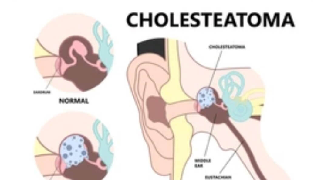 Cholesteotoma