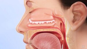 image of nasal polyps