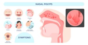 image of nasal polyps