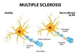 Multiple Sclerosis. World MS Day 