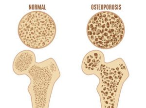 Osteoporosis .bone health