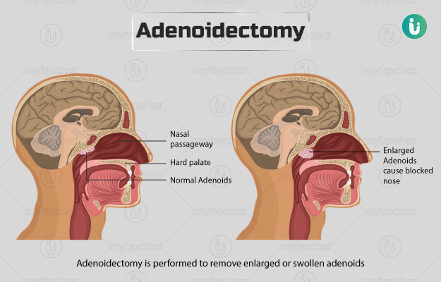 Cost of Adenoidectomy in India