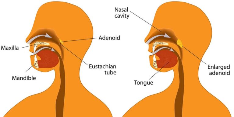 Coblation Adenoidectomy in India: Cost, Procedure & Insurance Explained