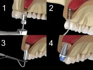 Image of sinus lift surgery