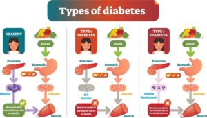 Types of diabetes