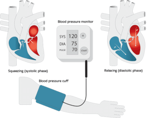 Image of High diastolic blood pressure treatment