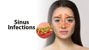 Sinus infections