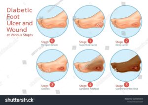 Image of Diabetic foot early signs