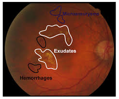 Image of early signs of diabetic retinopathy