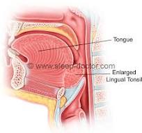 Image of lingual tonsillectomy