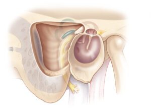 Image of Radical mastoid surgery