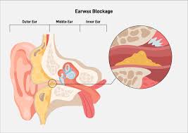 Image of How to remove ear wax blockage