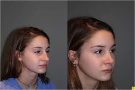 Image of What is the best age for rhinoplasty?