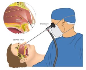 Image of sinus surgery