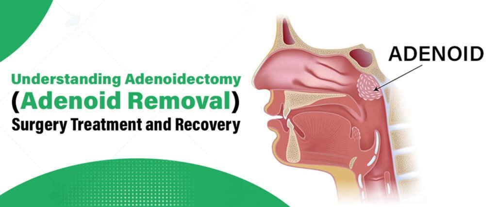 Cost of Adenoidectomy in Kerala