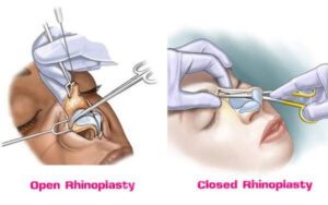 Image of Rhinoplasty surgery