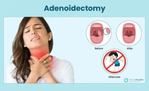 Cost of Adenoidectomy Surgery in Mumbai