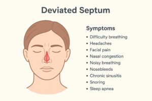Deviated nasal septum
