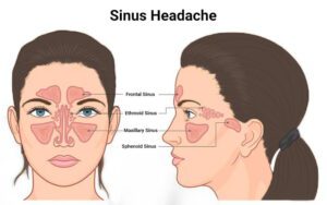 Image of How to rid of a sinus infection headache