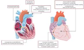 Images Of Pulmonary Hypertension Causes Heart failure