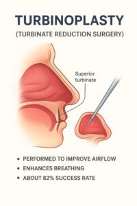 What Is Turbinoplasty?