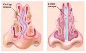 image of What is Submucosal Resection?