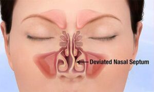image of Deviated septum surgery options