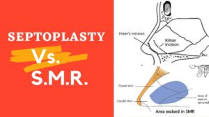 image of Difference Between SMR And Septoplasty