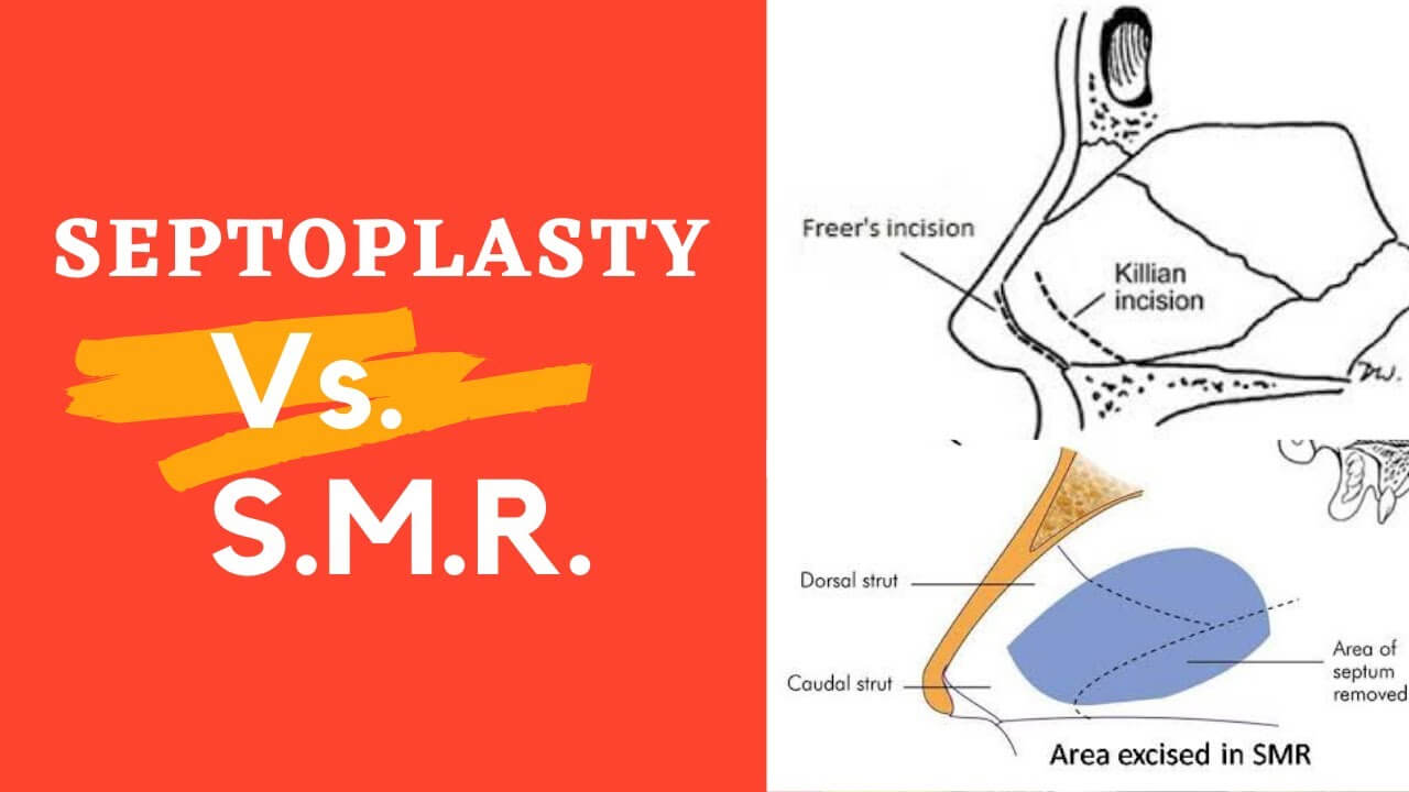 image of Difference Between SMR And Septoplasty