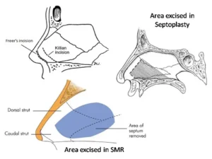 image of SMR vs Septoplasty