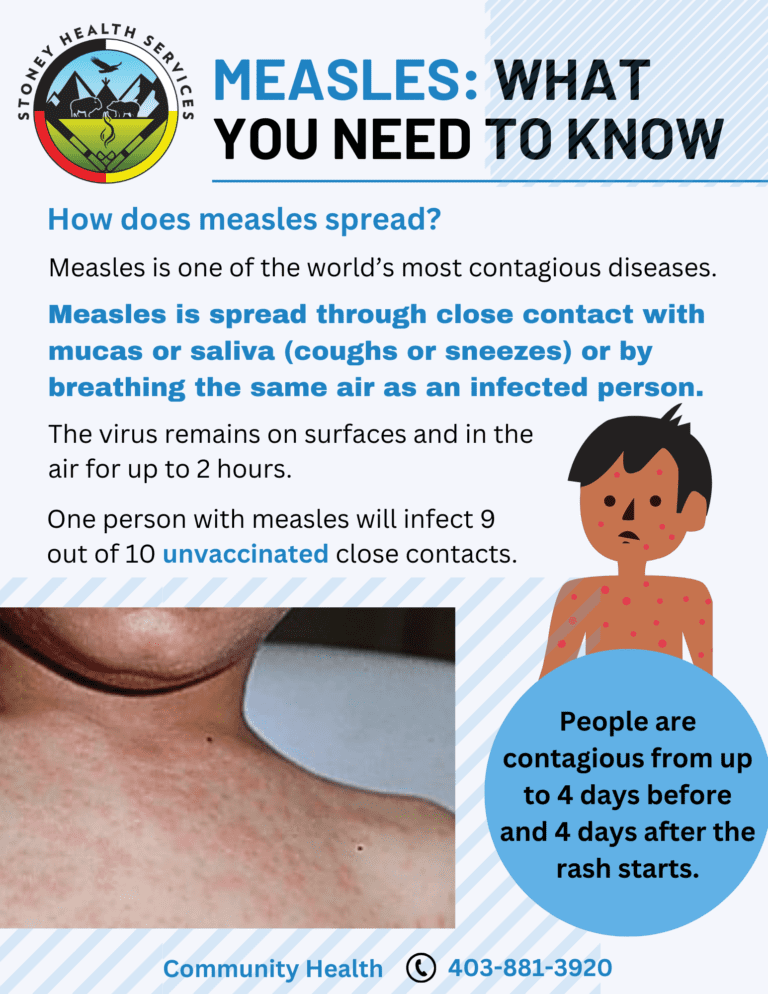 How Measles Spreads