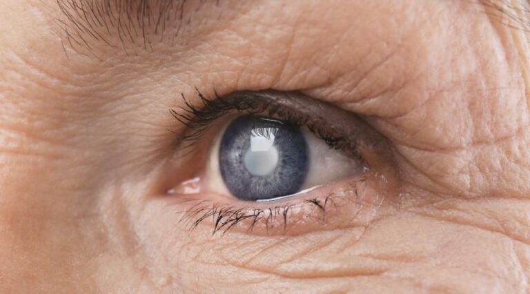 Image of Cortical Cataract causes